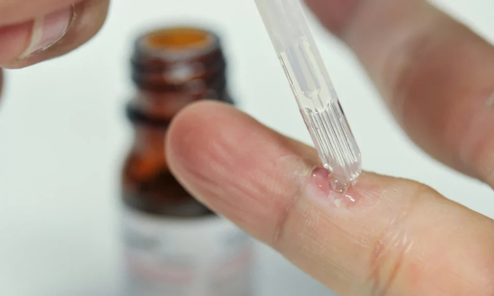 Wart Removal